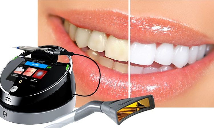 کاربردهای لیزر اپیک 10 در دندانپزشکی | بهترین ایمپلنت اصفهان
