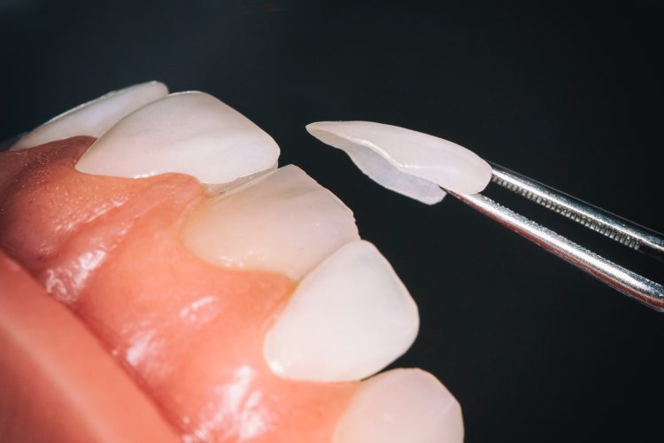 تطبيقات مختلفة من قشرة البورسلين | افضل دكتور اسنان تجميلي في اصفهان