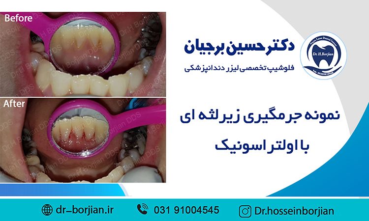 نمونه جرمگیری زیر لثه ای با اولتراسونیک (8)|بهترین دندانپزشک اصفهان