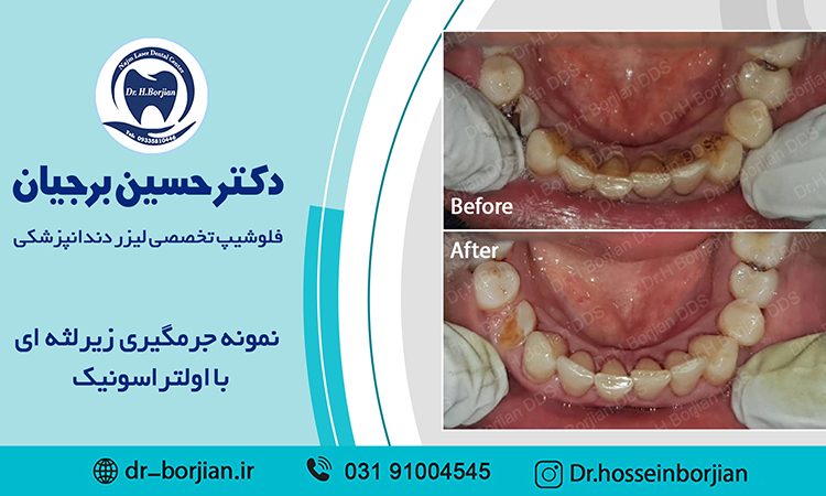 نمونه جرمگیری زیر لثه ای با اولتراسونیک (9)|بهترین دندانپزشک اصفهان
