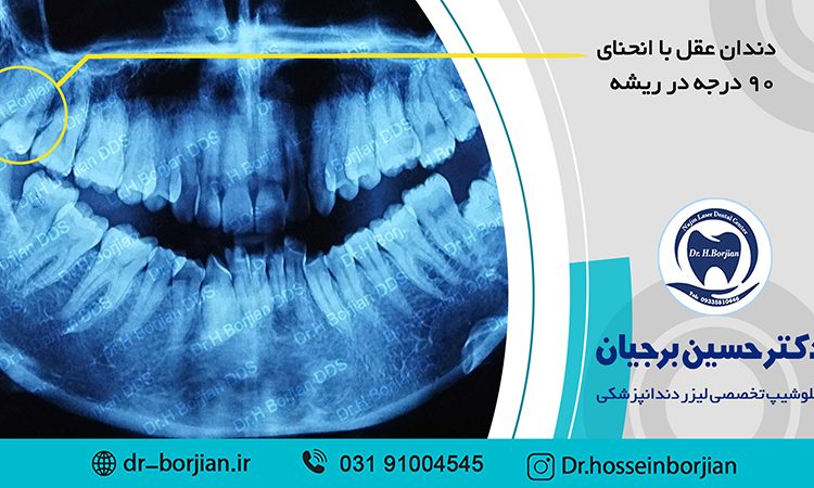 جراحی خارج کردن دندان عقل با انحنای 90 درجه در ریشه| بهترین دندانپزشک اصفهان