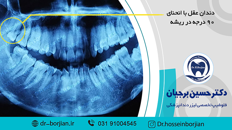 جراحی خارج کردن دندان عقل با انحنای 90 درجه در ریشه| بهترین دندانپزشک اصفهان