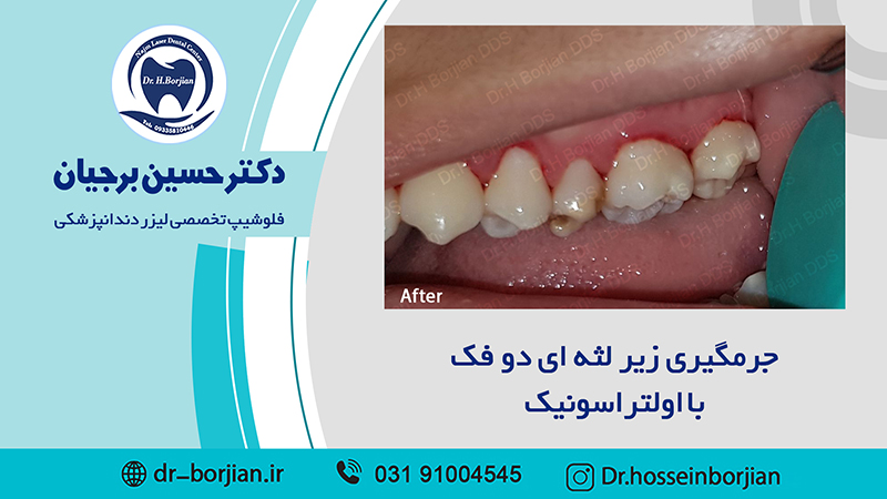 جرمگیری زیر لثه ای دو فک (10) | بهترین دندانپزشک اصفهان