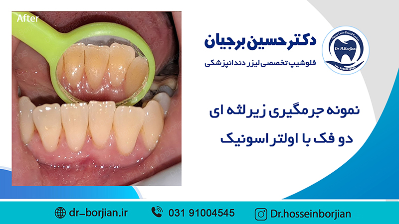 جرمگیری زیر لثه ای دو فک ( 11 )|بهترین دندانپزشک اصفهان