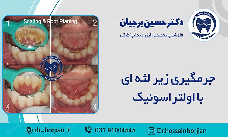 نمونه جرمگیری زیر لثه ای با اولتراسونیک (13)|بهترین دندانپزشک اصفهان