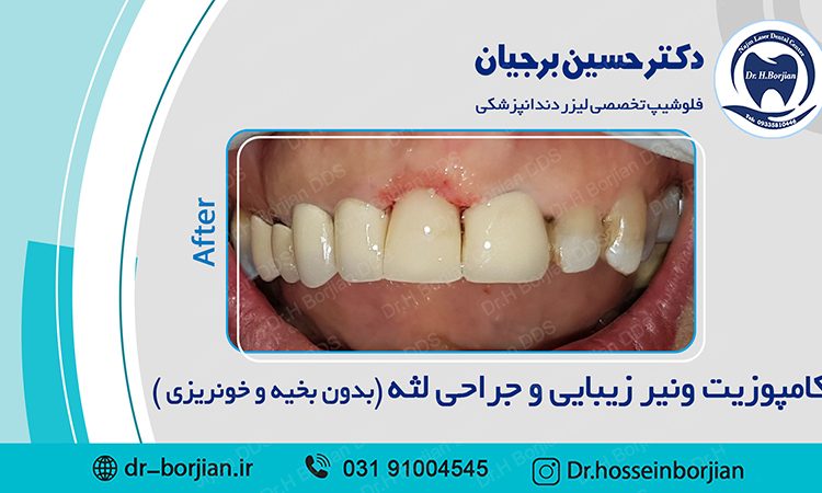 کامپوزیت ونیر زیبایی و جراحی لثه|بهترین دندانپزشک اصفهان