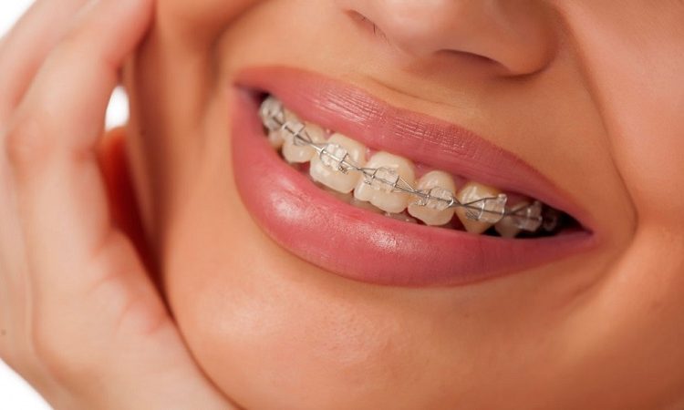 انواع ارتودنسی برای دندان‌های فک بالا | بهترین دندانپزشک زیبایی اصفهان