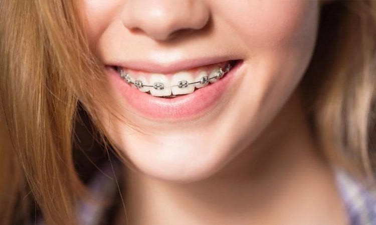 Types of orthodontic bonding | The best gum surgeon in Isfahan