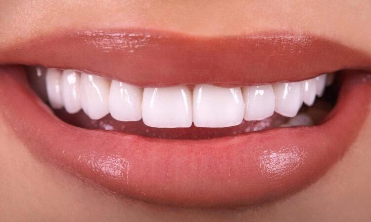 أنواع مختلفة من قشور الأسنان | افضل دكتور اسنان في اصفهان