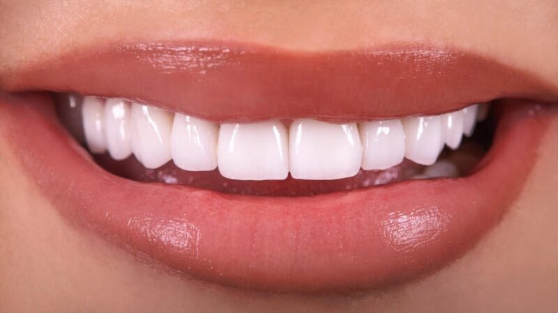 انواع مختلف روکش دندان | بهترین دندانپزشک اصفهان