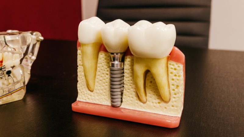 بیماری های محدود کننده کاشت ایمپلنت دندان | بهترین جراح لثه اصفهان