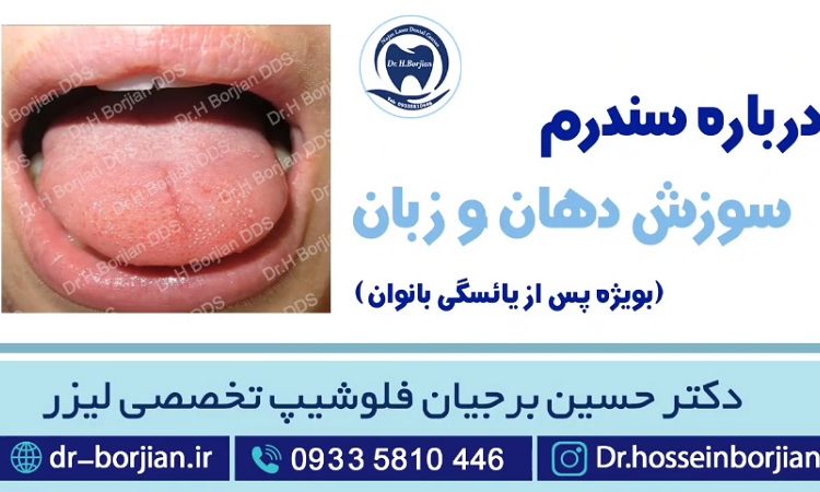 درمان سندرم سوزش دهان و زبان توسط بهترین دندانپزشک اصفهان