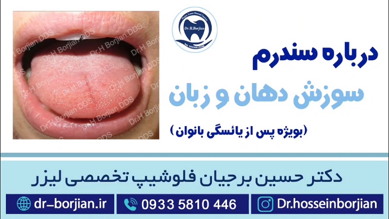 درمان سندرم سوزش دهان و زبان توسط بهترین دندانپزشک اصفهان