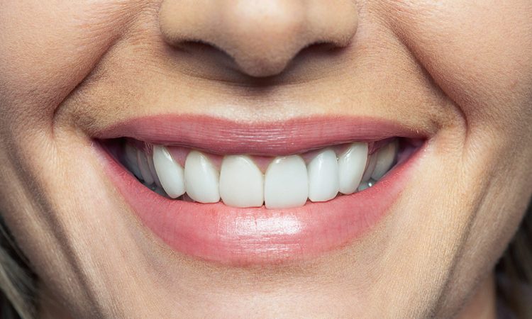 Reasons for receding gums | The best gum surgeon in Isfahan