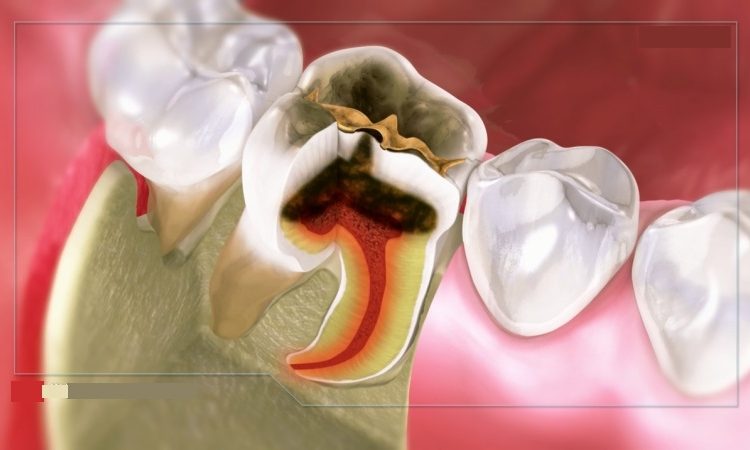 طرق علاج الأسنان التالفة واستعادتها | افضل دكتور اسنان في اصفهان