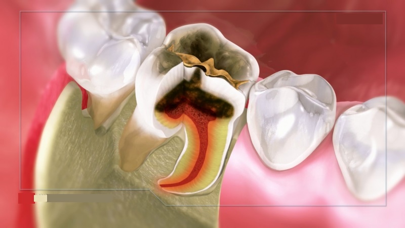 راه های درمان و ترمیم دندان پوسیده | بهترین دندانپزشک اصفهان