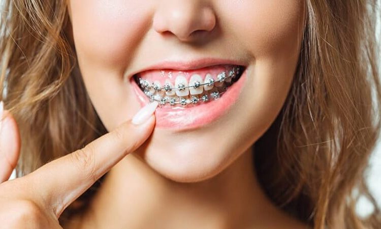 Symptoms of the need for orthodontics | The best dentist in Isfahan