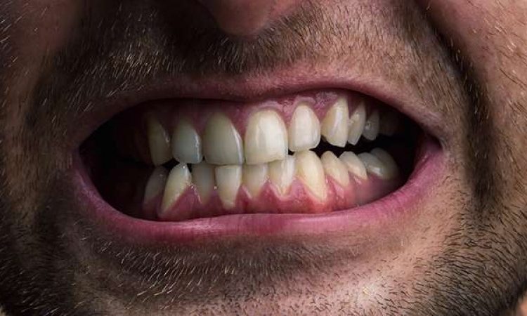 أسباب اعوجاج الأسنان | أفضل جراح لثة في اصفهان