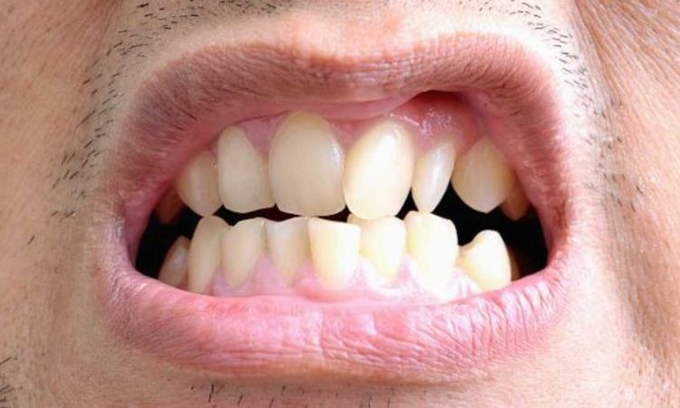 مشاكل الأسنان الملتوية وغير المنتظمة | افضل دكتور اسنان في اصفهان