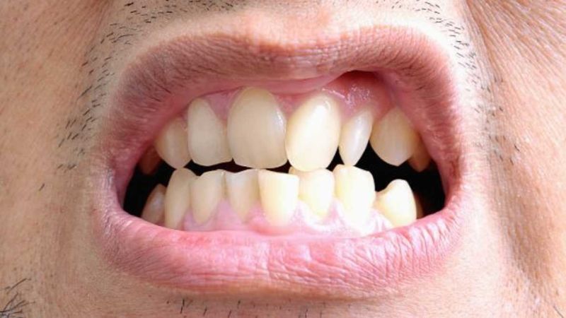مشکلات مرتبط با دندان‌های کج و نامرتب | بهترین دندانپزشک اصفهان