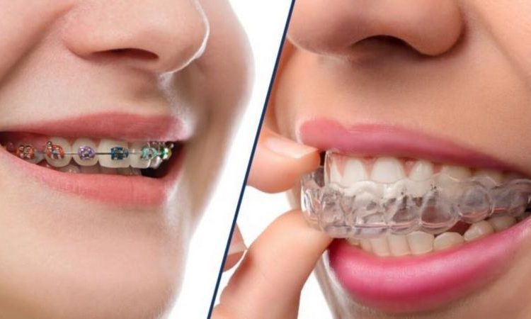 مقارنة تقويم الأسنان الثابت والمتحرك | أفضل جراح لثة في اصفهان