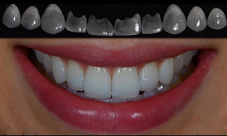 Comparaison des différences entre le stratifié et les facettes dentaires | Le meilleur dentiste d'Ispahan