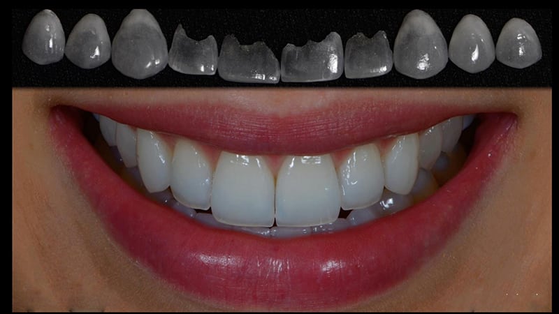 مقایسه تفاوت های لمینت و روکش دندان | بهترین دندانپزشک اصفهان