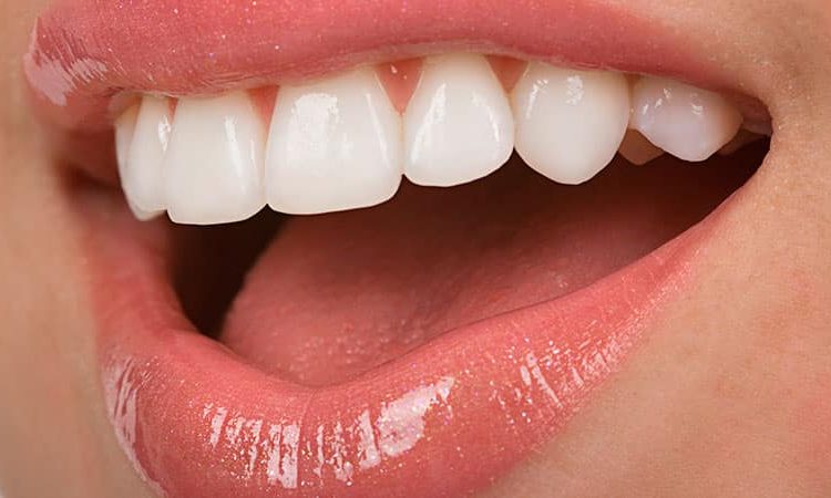 مقایسه لمینت سرامیکی با لومینرها | بهترین دندانپزشک زیبایی اصفهان
