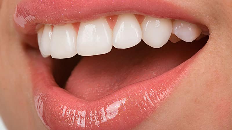 مقایسه لمینت سرامیکی با لومینرها | بهترین دندانپزشک زیبایی اصفهان
