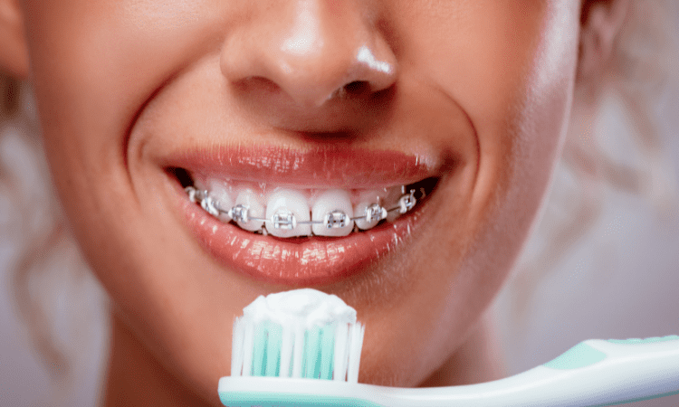 پیشگیری از پوسیدگی دندان در طول ارتودنسی | بهترین دندانپزشک زیبایی اصفهان