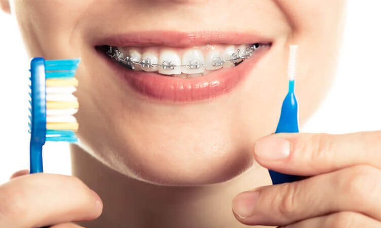 پیشگیری و رفع لکه‌های سفید روی دندان در حین ارتودنسی | بهترین دندانپزشک زیبایی اصفهان