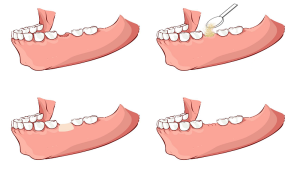 The best dentist in Isfahan - the best gum surgeon in Isfahan - the price of dental implants in Isfahan| Dr. Hossein Borjian