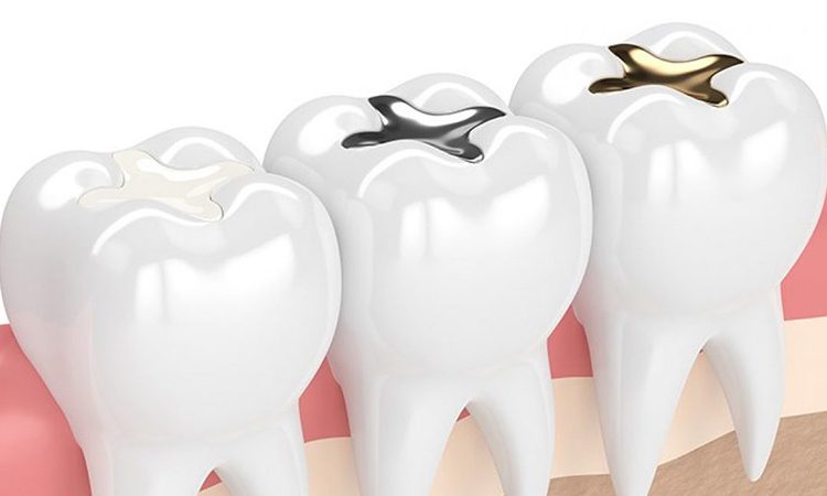 Comment obturer les dents avec du composite et de l'amalgame | Le meilleur dentiste d'Ispahan