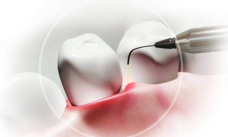 Applications laser en dentisterie | Le meilleur chirurgien des gencives à Ispahan