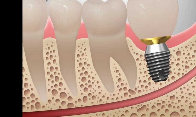 کاشت ایمپلنت پایه کوتاه | بهترین دندانپزشک زیبایی اصفهان