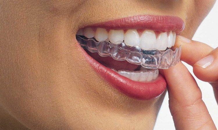 گزینه های درمانی صاف کردن دندان‌ها | بهترین دندانپزشک زیبایی اصفهان