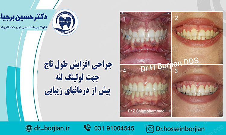 بخشی از کتاب یک دهه با لیزر دندانپزشکی (جراحی افزایش طول تاج)|بهترین دندانپزشک اصفهان