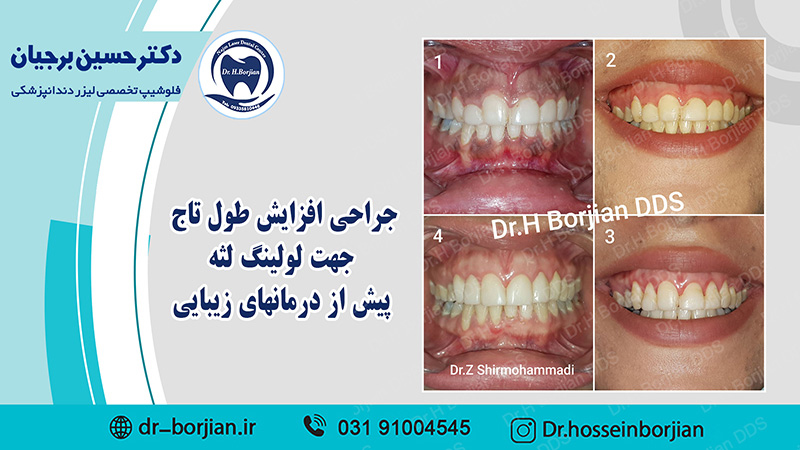 بخشی از کتاب یک دهه با لیزر دندانپزشکی (جراحی افزایش طول تاج)|بهترین دندانپزشک اصفهان