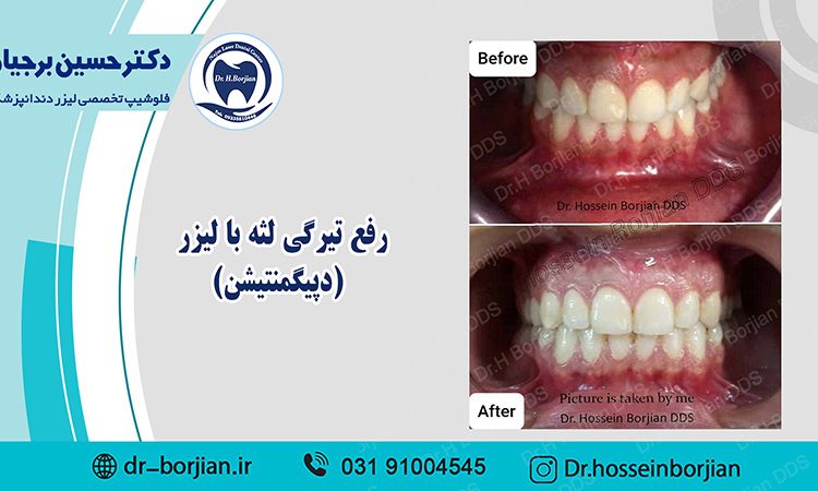 بخشی از کتاب یک دهه با لیزر دندانپزشکی (رفع تیرگی لثه با لیزر )|بهترین دندانپزشک اصفهان