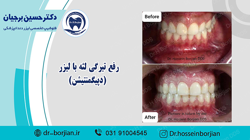 بخشی از کتاب یک دهه با لیزر دندانپزشکی (رفع تیرگی لثه با لیزر )|بهترین دندانپزشک اصفهان