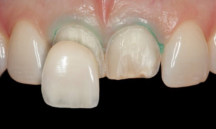 بررسی مزایا و معایب روکش پرسلن به فلز | بهترین دندانپزشک اصفهان