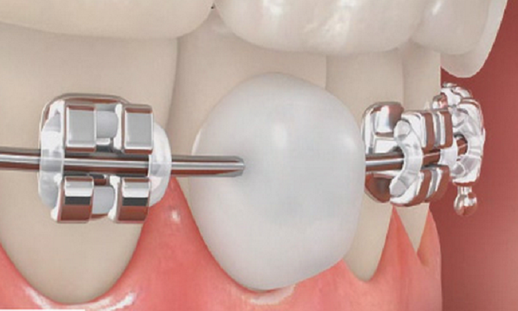 Revue de cire orthodontique | Le meilleur implant à Ispahan