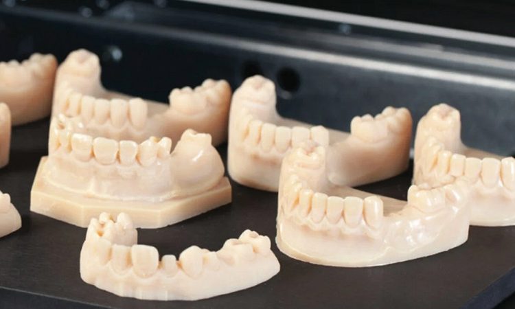 Review and comparison of digital and traditional molding | The best implant in Isfahan