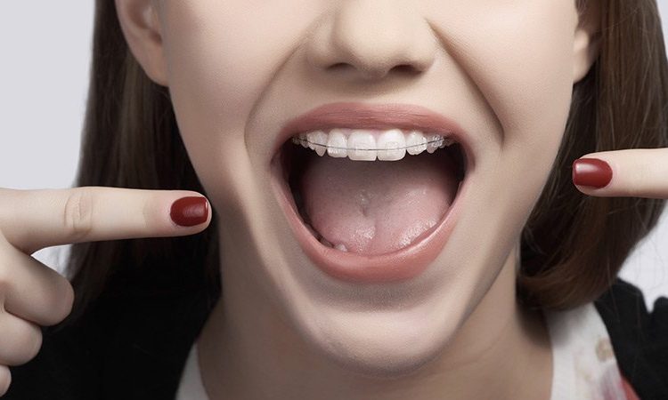 Façons de pratiquer l'orthodontie préventive | Le meilleur implant à Ispahan