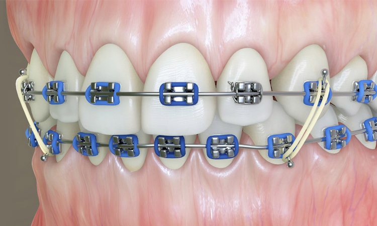 Guide to choosing the color of orthodontic braces | The best gum surgeon in Isfahan