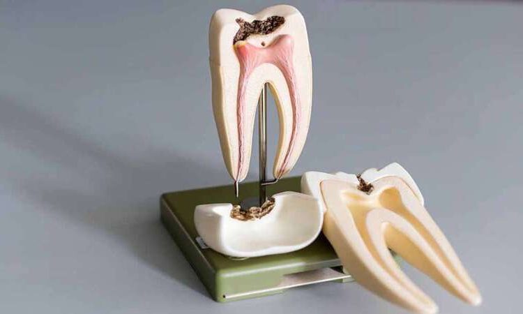 علل و علائم هشدار دهنده بروز پوسیدگی در دندان | بهترین دندانپزشک اصفهان