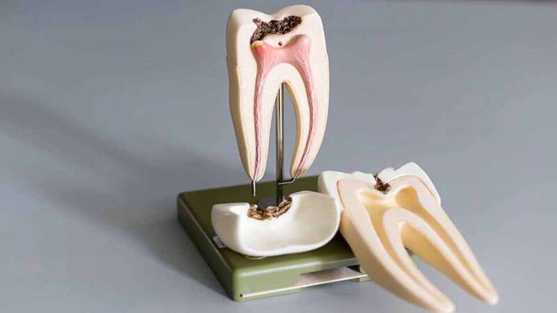 علل و علائم هشدار دهنده بروز پوسیدگی در دندان | بهترین دندانپزشک اصفهان