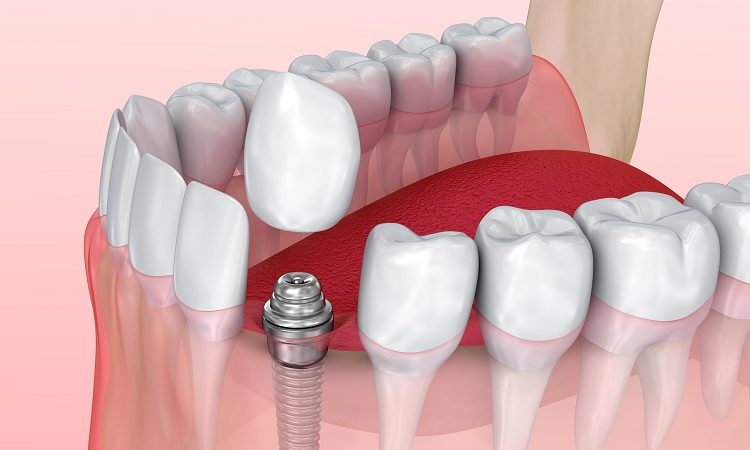مراحل کاشت ایمپلنت دندان جلو | بهترین ایمپلنت اصفهان