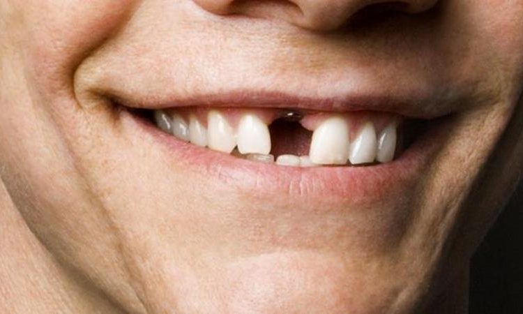 Advantages of front tooth implants | The best cosmetic dentist in Isfahan