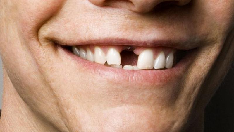 مزایای ایمپلنت دندان جلو | بهترین دندانپزشک زیبایی اصفهان